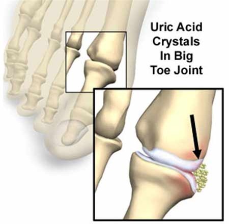 Nồng độ axit uric trong máu cao – Có phải mắc gút? 1