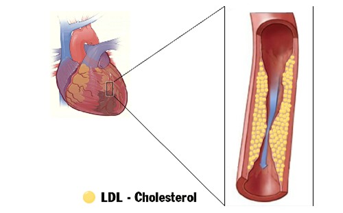 Rối loạn mỡ máu thúc đẩy quá trình xơ vữa động mạch, gây nhồi máu cơ tim.