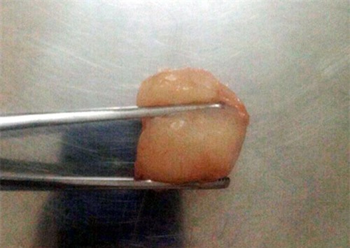 Đầu hè trẻ đã liên tục tử vong vì hóc - 2