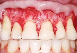 Sử dụng thuốc tẩy trắng răng không rõ nguồn gốc hoặc dùng với lượng lớn và dài ngày có thể hỏng răng, lợi, thậm chí gây ung thư lưỡi, vòm họng.