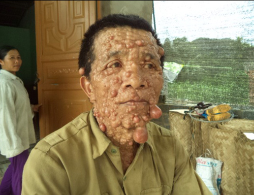 2014: 6 căn bệnh kỳ lạ nhất Việt Nam - Ảnh 3