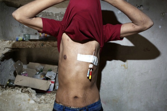 Bức ảnh chụp Ghaffar Naghdi với những vết sẹo từ việc điều trị bệnh suy thận ba lần/ tuần trong suốt 6 năm qua. 
