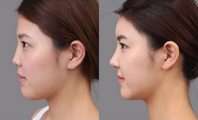  Nâng mũi cũng là lựa chọn của nhiều khách hàng khi đa số người Hàn Quốc nói riêng và người châu Á nói chung có khuôn mũi thấp.