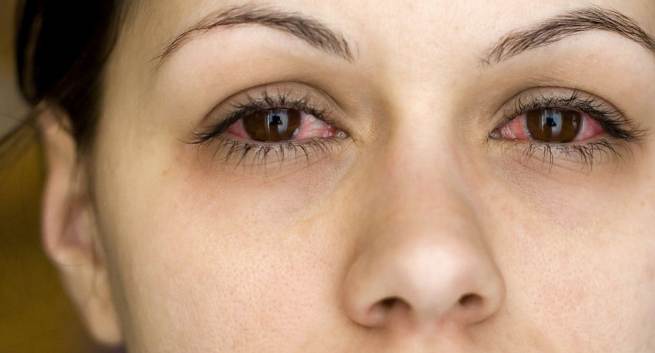 5 mẹo đơn giản chữa đau mắt đỏ ngay tại nhà - Ảnh 1