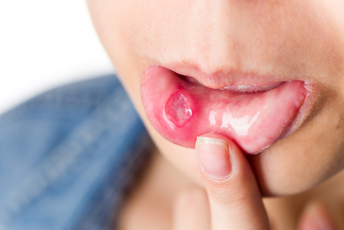 8 nguyên nhân gây loét miệng bạn cần phải biết - Ảnh 1