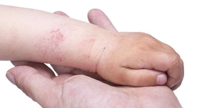 10 biện pháp tại nhà giúp bạn đối phó với bệnh eczema - Ảnh 1