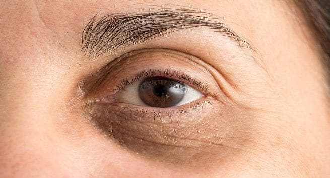 5 biện pháp tự nhiên giúp giảm quầng thâm mắt - Ảnh 1