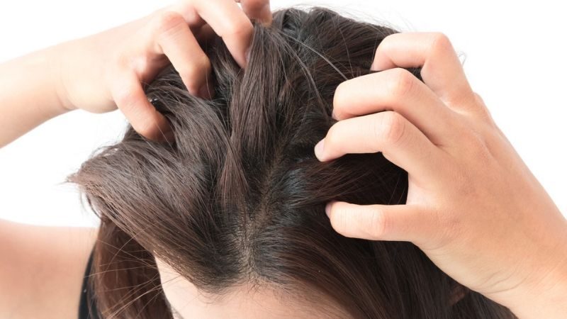 4 biện pháp tự nhiên trị ngứa da đầu hiệu quả tại nhà - Ảnh 1