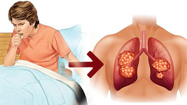 6 dấu hiệu cảnh báo phổi của bạn đang “kêu cứu” - Ảnh 1
